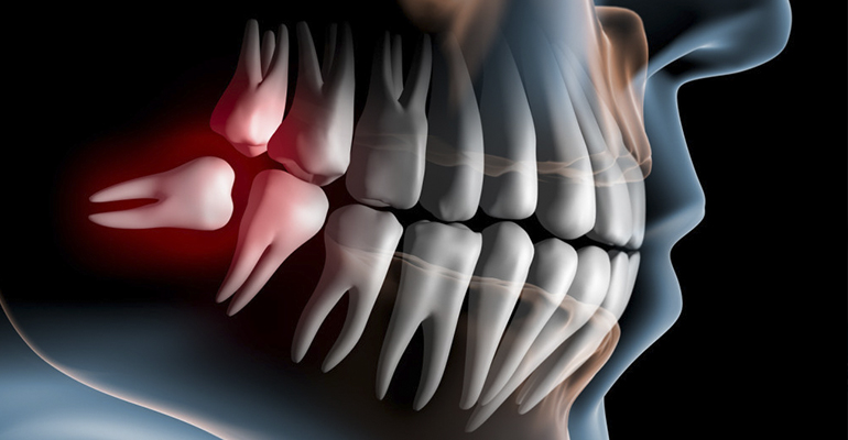 Cirugia tercer molar
