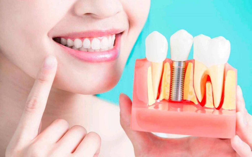 Implantes dentales quito