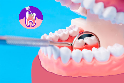 endodoncia quito
