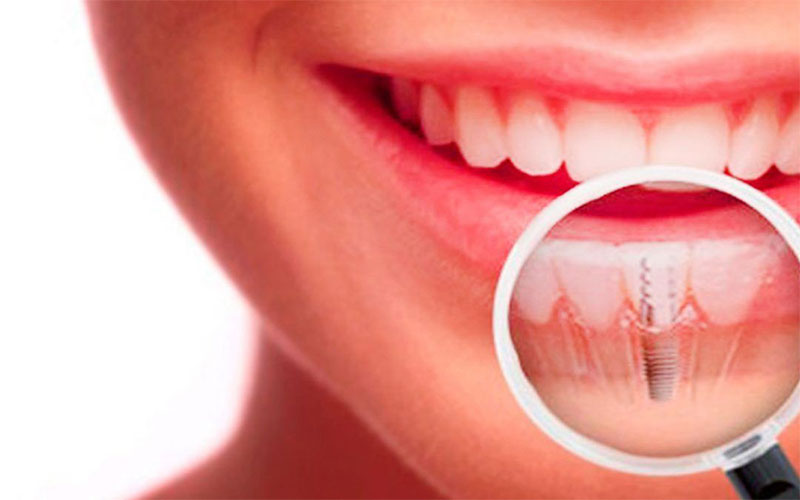 implantes dentales